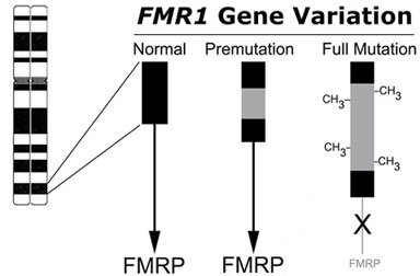 Chromosome Mutation What Causes Fragile X Syndrome A single gene shuts down Chromosome Mutation What Causes Fragile X Syndrome A single gene shuts down