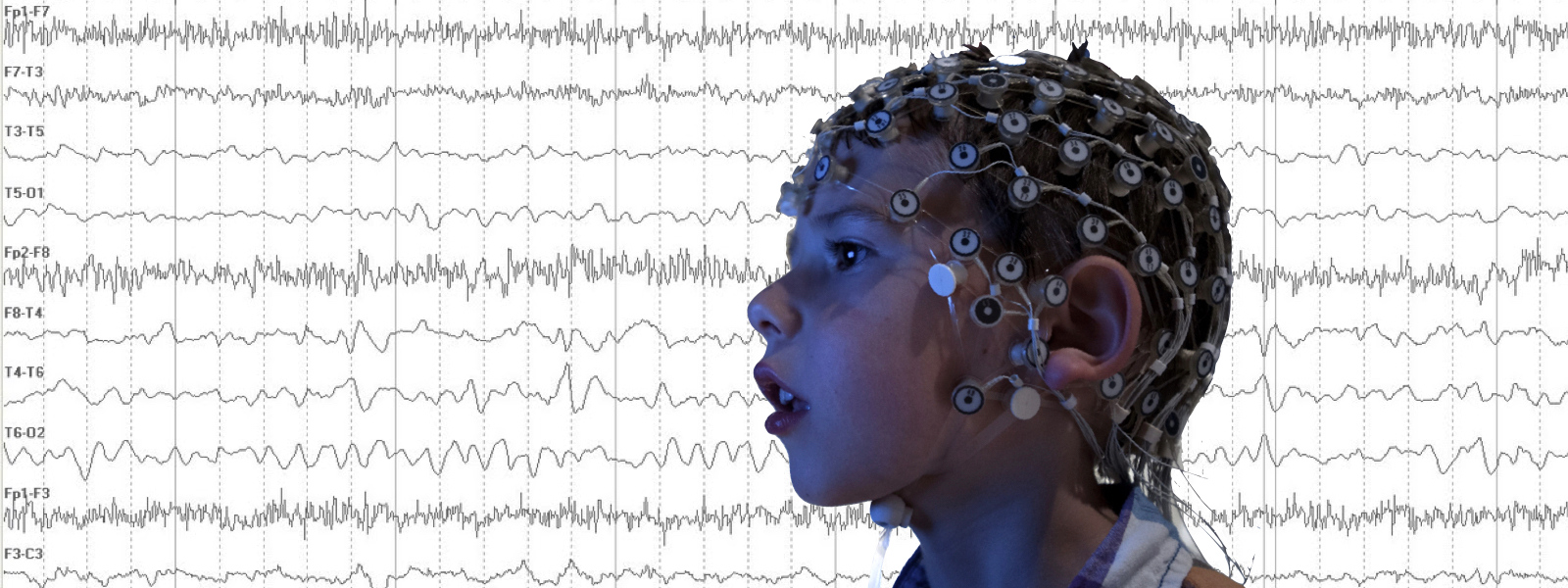 EEG-NeuralMarker Neural Markers of Fragile X: A Powerful New Tool for Clinical Trials