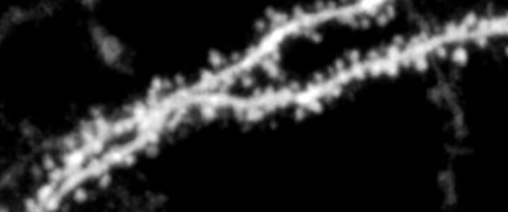 New Research Targets NMDA Receptor – A Key Player in Brain Communication and Fragile X Syndrome High-resolution image of dendritic spines—tiny structures on neurons that are altered in Fragile X syndrome.